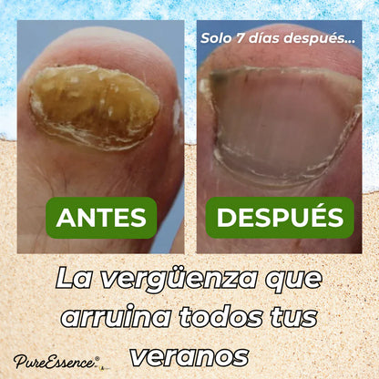 ¿Ocultas tus uñas? PureEssence® las cambia en 7 días | Pagás solo 1 y te llevás 3 en total