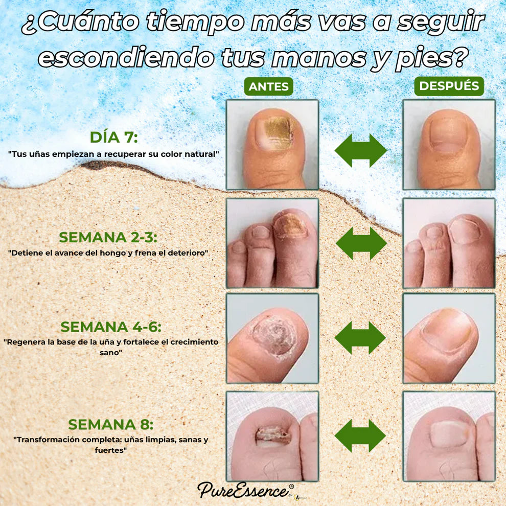 ¿Ocultas tus uñas? PureEssence® las cambia en 7 días | Pagás solo 1 y te llevás 3 en total