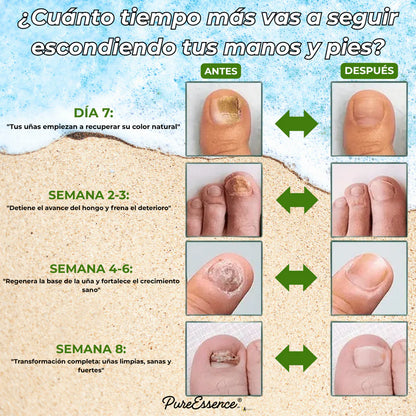 ¿Ocultas tus uñas? PureEssence® las cambia en 7 días | Pagás solo 1 y te llevás 3 en total
